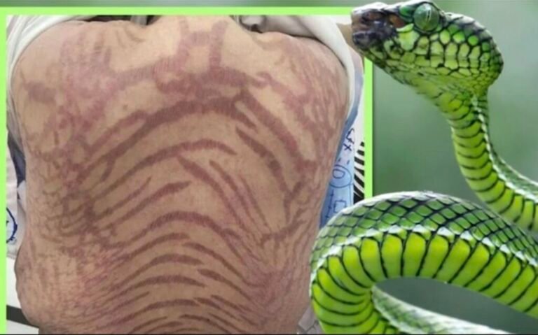 பாம்பு தோலாக மாறி…. பெண்ணுக்கு காத்திருந்த அதிர்ச்சி…. மருத்துவர் எச்சரிக்கை….!! 