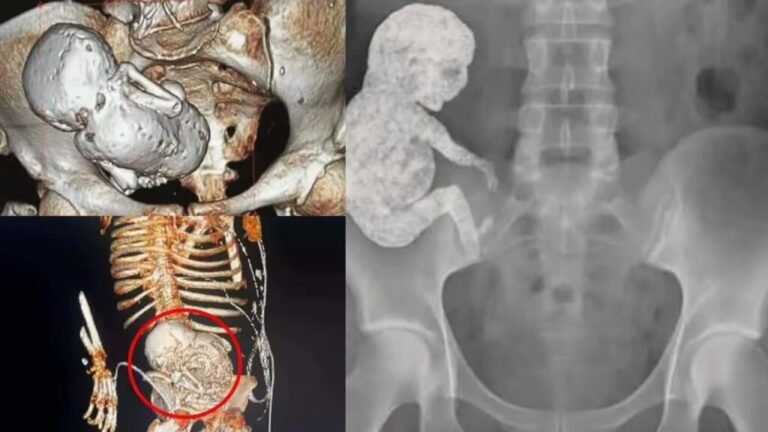 “மெடிக்கல் மிராக்கிள் 40 வருட கருவா?”.. 82 வயது பாட்டியின் வயிற்றில் அதிசயம்