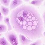 கணையப் புற்றுநோய் சிகிச்சையில் மாபெரும் வெற்றி  