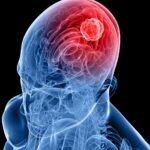 மூளைக் கட்டிகளை துல்லியமாகக் கண்டறியும் ரத்தப் பரிசோதனை முறையைக் கண்டறிந்த விஞ்ஞானிகள்  