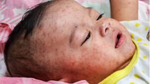 பங்களாதேஷில் தட்டம்மை பரவல்: பலி எண்ணிக்கை 300ஐ தாண்டியது  