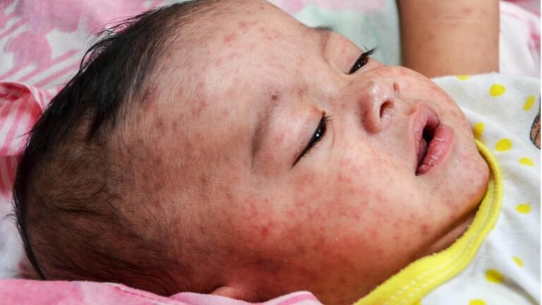பங்களாதேஷில் தட்டம்மை பரவல்: பலி எண்ணிக்கை 300ஐ தாண்டியது  